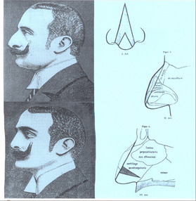 Jacques Joseph (1865–1934). Ein Streifzug durch die Geschichte der Schönheitschirurgie 